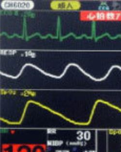 心電図モニター