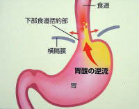 逆流性食道炎