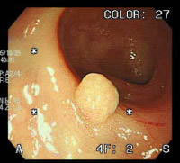 大腸ポリープ2